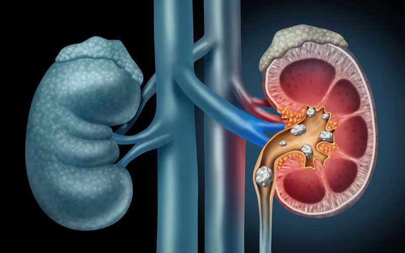سنگ کلیه: شناسایی و پیشگیری، علائم و عوامل خطر و باورهای غلط رایج