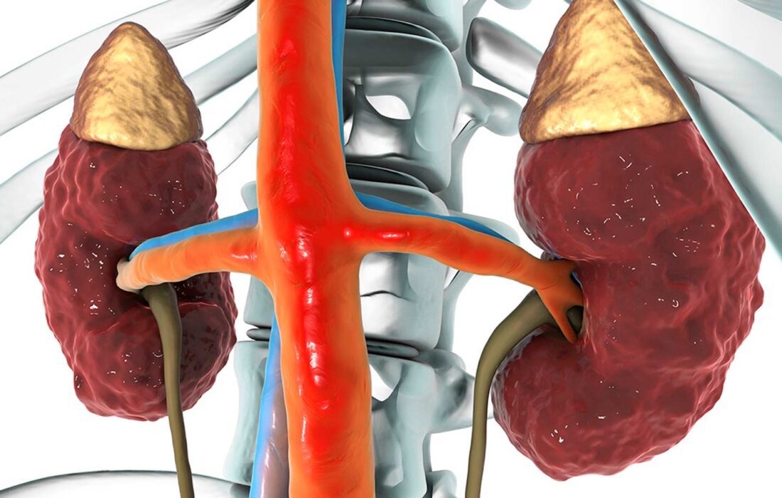 بیماری‌های کلیوی چگونه تشخیص داده می‌شوند؟