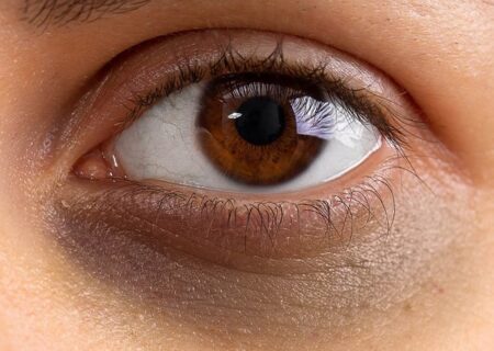 راز از بین بردن سیاهی دور چشم با این ۳ ویتامین!