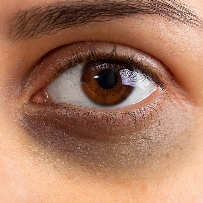 راز از بین بردن سیاهی دور چشم با این ۳ ویتامین!