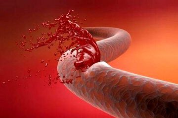 مصرف بی‌رویه ویتامین E خطر خونریزی را افزایش می‌دهد