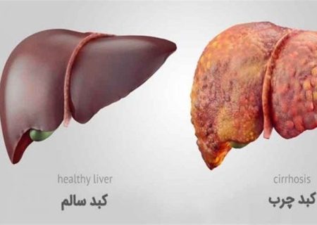 علائم کبد چرب چیست؟ ۸ نشانه هشداردهنده بیماری خاموش کبد